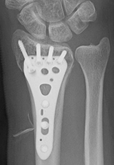 術後：中間位設置型掌側ロッキングプレートを用いた手術
