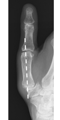 骨切り前：第１中手骨が橈背側に亜脱臼を認める