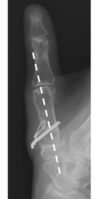 骨切り後：第１中手骨の亜脱臼が整復され、関節の適合性が改善