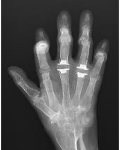 術後：示指〜小指MP関節に対して、指用人工関節置換術を施行