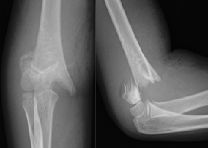 術前：転倒により受傷した上腕骨顆上骨折の症例