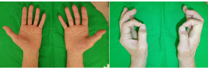 術前：右母指球筋の高度萎縮と対立障害を認める