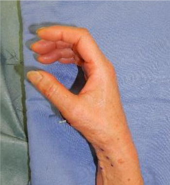 術後：腕神経叢ブロック下（日帰り）に母指対立再建術(Camitz法)を施行