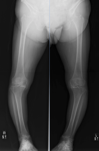 人工膝関節全置換術：Total Knee Arthroplasty (TKA)