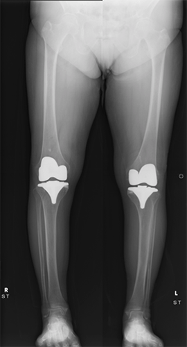 人工膝関節全置換術：Total Knee Arthroplasty (TKA)