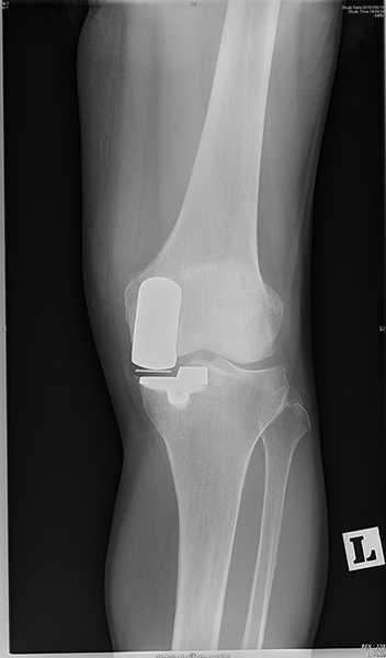 人工膝関節単顆置換術：Unicompartmental Knee Arthroplasty (UKA)