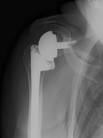 リバース型人工肩関節全置換術：Reverse Total Shoulder Arthroplasty (RSA)