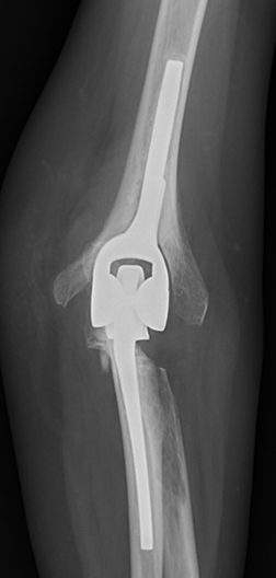 人工肘関節全置換術：Total Elbow Arthroplasty (TEA)