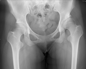 寛骨臼回転骨切り術：Rotational Acetabular Osteotomy (RAO)