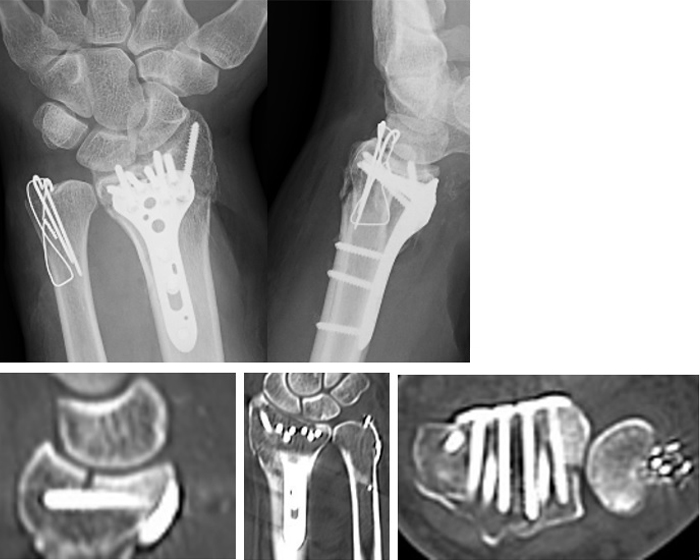 術後：遠位設置型掌側ロッキングプレートを用いた手術