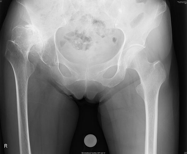 人工股関節全置換術：Total Hip Arthroplasty (THA)