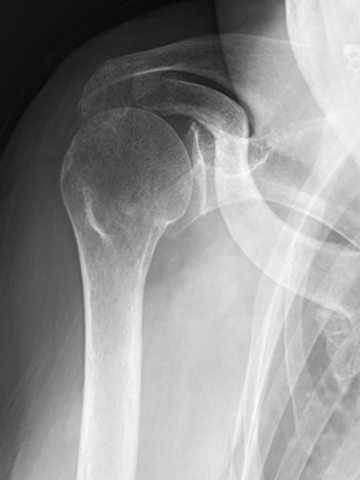 リバース型人工肩関節全置換術：Reverse Total Shoulder Arthroplasty (RSA)