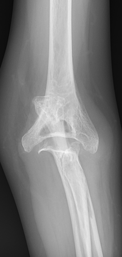 人工肘関節全置換術：Total Elbow Arthroplasty (TEA)