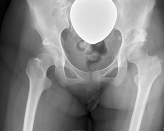 寛骨臼回転骨切り術：Rotational Acetabular Osteotomy (RAO)