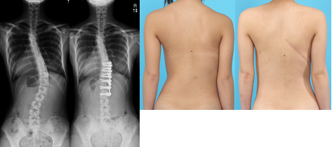 思春期特発性側弯症（17歳・女子）